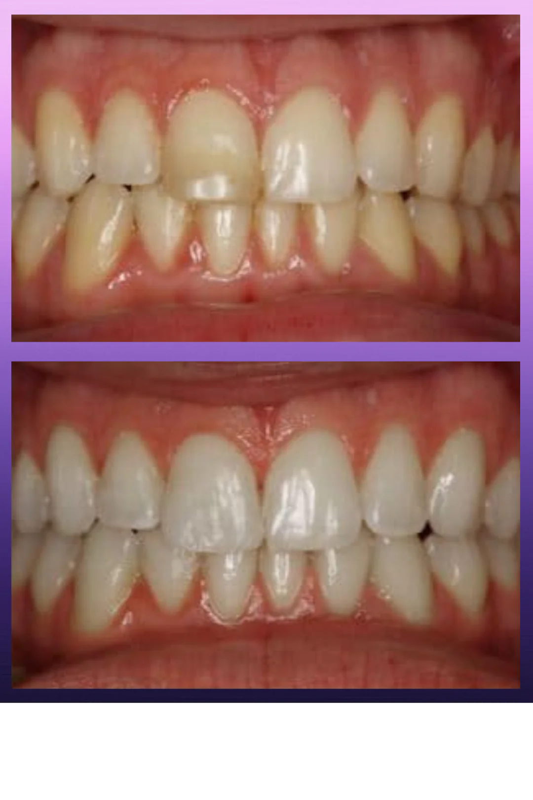 Blanqueador Dental Morada v34 - ZayahSmile