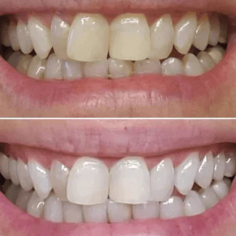 Blanqueador Dental Morada v34 - ZayahSmile